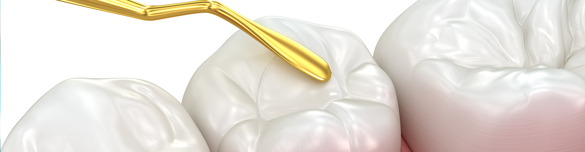 dental tool pressing white material into hole in tooth